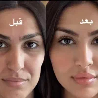 جشنواره تخفیفات پی آر پی مو و صورت و مزوتراپی