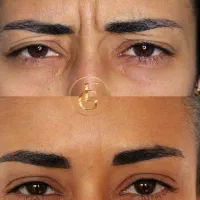 بوتاکس چشم گربه ای تضمینی پی ار اف آنزیم|خدمات آرایشگری و زیبایی|کرج, گوهردشت|دیوار