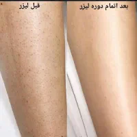 آف لیزر موی زائد بانوان دزفول فولبادی  ۴۷۰ تضمینی