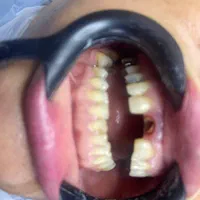 کامپوزیت دندان فقط فکی 5|خدمات آرایشگری و زیبایی|ملارد, |دیوار