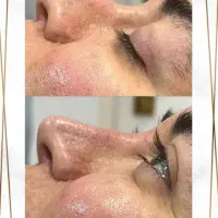 بلفاروپلاستی ۴۵۰۰/غبغب۴۵۰۰/کاشت ابرو|خدمات آرایشگری و زیبایی|ری, دیلمان|دیوار