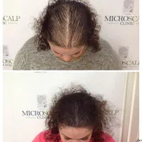 میکرواسکالپ / اسکالپ جایگزین کاشت مو تضمینی|خدمات آرایشگری و زیبایی|مشهد, شهید فرامرز عباسی|دیوار
