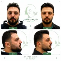 عمل بینی طبیعی تنفسی لیفت جراح متخصصENTمجید کاظمی|خدمات زیبایی و سلامت|تهران, قبا|دیوار