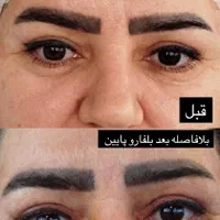 بلفارو، بوتاکس، ژل، هایفو، ساکشن شکم و غبغب