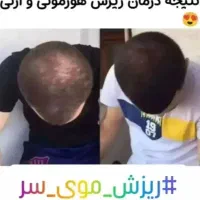 پک ریزش و رویش مجدد مو|آرایشی، بهداشتی، درمانی|تهران, فلاح|دیوار
