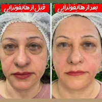 با هایفو ۱۰ سال جوانتر شو|خدمات زیبایی و سلامت|اهواز, کیانپارس |دیوار