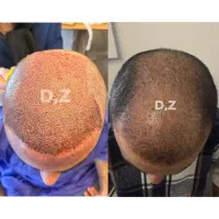 کاشت مو فول تراکم شیرازی در ساری|خدمات آرایشگری و زیبایی|ساری, |دیوار