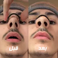 نازال استریپ ، گیره رفع خروپف مدل مگنتی|تجهیزات ورزشی|شیراز, کوی طلاب|دیوار