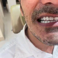 دندانسازی دندان مصنوعی|خدمات آرایشگری و زیبایی|مشهد, هفت تیر (آب و برق)|دیوار