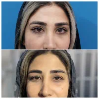 مرکز تخصصی بلفاروپلاستی مشهد ، جراحی پلک مشهد|خدمات آرایشگری و زیبایی|مشهد, احمدآباد|دیوار