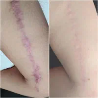 جوانساز پی آر پیprp صورت و ریزش مو و زخم و لک|خدمات آرایشگری و زیبایی|هشتگرد, شهرک ولیعصر (مصلی)|دیوار