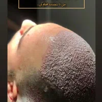 همکاری با لیدر عرب زبان کاشت مو