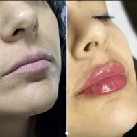 تخفیف ویژه بوتاکس
