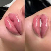 ژل بوتاکس لاغری فیلربادی جوانساز