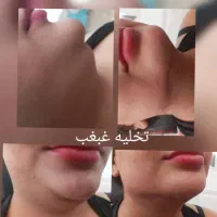 تزریق تخصصی ژل لب تزریق بادی لیفت نخ و چربی|خدمات آرایشگری و زیبایی|خرمشهر, |دیوار