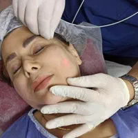 اندولیفت/ جوانسازی /تخلیه چربی صورت / رفع سلولیت|خدمات آرایشگری و زیبایی|تهران, صادقیه|دیوار