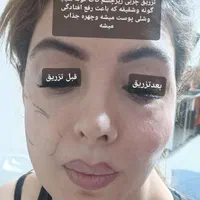 ساکشن وتزریق چربی فیلروبوتاکس وپی ارپی سروصورت ونخ