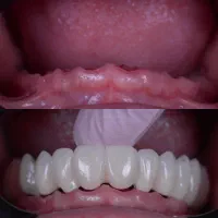 دندانپزشکی ایمپلنت دیجیتال و فوری با اقساط بلندمدت|خدمات آرایشگری و زیبایی|تبریز, |دیوار