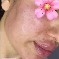 تزریق فیلر(ژل و بوتاکس)|خدمات آرایشگری و زیبایی|خرم‌آباد, |دیوار