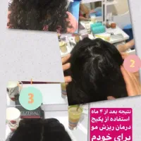افزایش رشد موی سر و ریش صورت|آرایشی، بهداشتی، درمانی|اصفهان, مصلی|دیوار