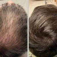 حیف نیست موهات داره خالی میشه