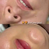 تزریقات ژل و بوتاکس و آنزیم|خدمات آرایشگری و زیبایی|اسلام‌شهر, شهرک مهدیه|دیوار