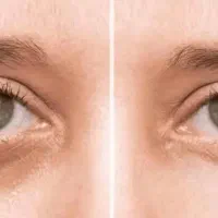 سفید کردن و وایتینگ نواحی مختلف