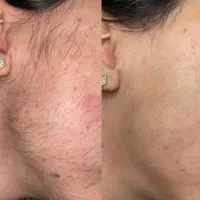 الکترولیزحذف دائم موهای زائدسیاه و سفیدوکرکی/لیزر