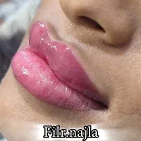 ژل ،فیلر، بوتاکس