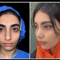 عمل بینی در تخفیفات پاییز