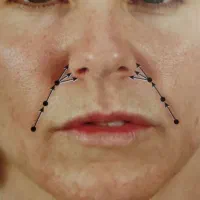 انجام خدمات لیفت نخ ، فیلر، بوتاکس