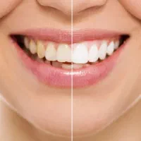 سفید کردن (bleaching) دندان در منزل