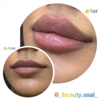 تزریق فیلر،ژل لب،فیلربینی|خدمات آرایشگری و زیبایی|شیراز, ریشمک|دیوار