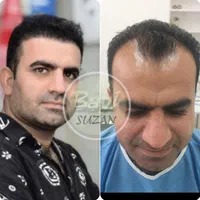 کاشت مو طبیعی سر و ابرو و ریش با ضمانت نامه کتبی|خدمات آرایشگری و زیبایی|اهواز, کیانپارس |دیوار