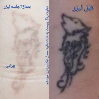 پاک کردن تاتوبالیزرکیوسوییچ|خدمات آرایشگری و زیبایی|مشهد, گلشور|دیوار