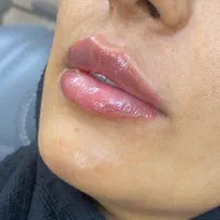 ژل لب متود روسی توسط پزشک حرفه ای|خدمات آرایشگری و زیبایی|حمیدیا, |دیوار