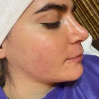 جشنواره فشیال تخصصی،اسکالپ سر ،50 درصد آف|خدمات زیبایی و سلامت|مشهد, الهیه|دیوار