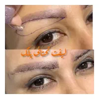 بلفارو بوتاکس لیفت شقیقه