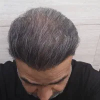 کاشت مو‌و ابرو درمان ریزش مو و ابرو و ریش