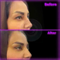 جشنواره ویژه بلفاروپلاستی(جراحی زیبایی پلک)|خدمات آرایشگری و زیبایی|دیلم, |دیوار