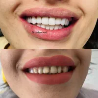 شرایط ویژه کامپوزیت دندان در تهران