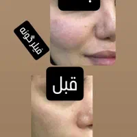 تزریق ژل وبوتاکس با بهترین قیمت در برازجان|خدمات آرایشگری و زیبایی|برازجان, |دیوار