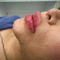 جذب نیروی لیزر و ماساژ با کیس فعال در کلینیک