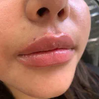تخفیفات آنزیم بوتاکس صورت فیلر فول فیس و...|خدمات آرایشگری و زیبایی|مشهد, شهید فرامرز عباسی|دیوار