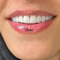 بیماریاب بازاریاب دندانپزشکی. کامپوزیت