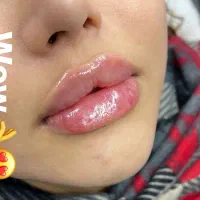 آف یلدایی تزریق ژل و بوتاکس|خدمات آرایشگری و زیبایی|ملایر, |دیوار