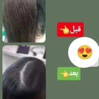 درمان قطعی شپش|آرایشی، بهداشتی، درمانی|پاکدشت, پاکدشت (مامازند)|دیوار