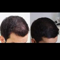 انجام تضمینی مزو وپی ارپی بابالاترین کیفیت