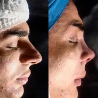 جراحی بینی ۲۴ بدون بیهوشی