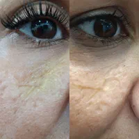 برداشتن انواع خال.جراحی غدد.جای سالک.زخم.سوختگی|خدمات آرایشگری و زیبایی|مشهد, هنرستان|دیوار